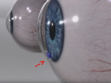 Eye Implant Device could Save Glaucoma Patients